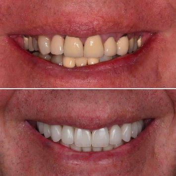 A before and after picture of a person's teeth