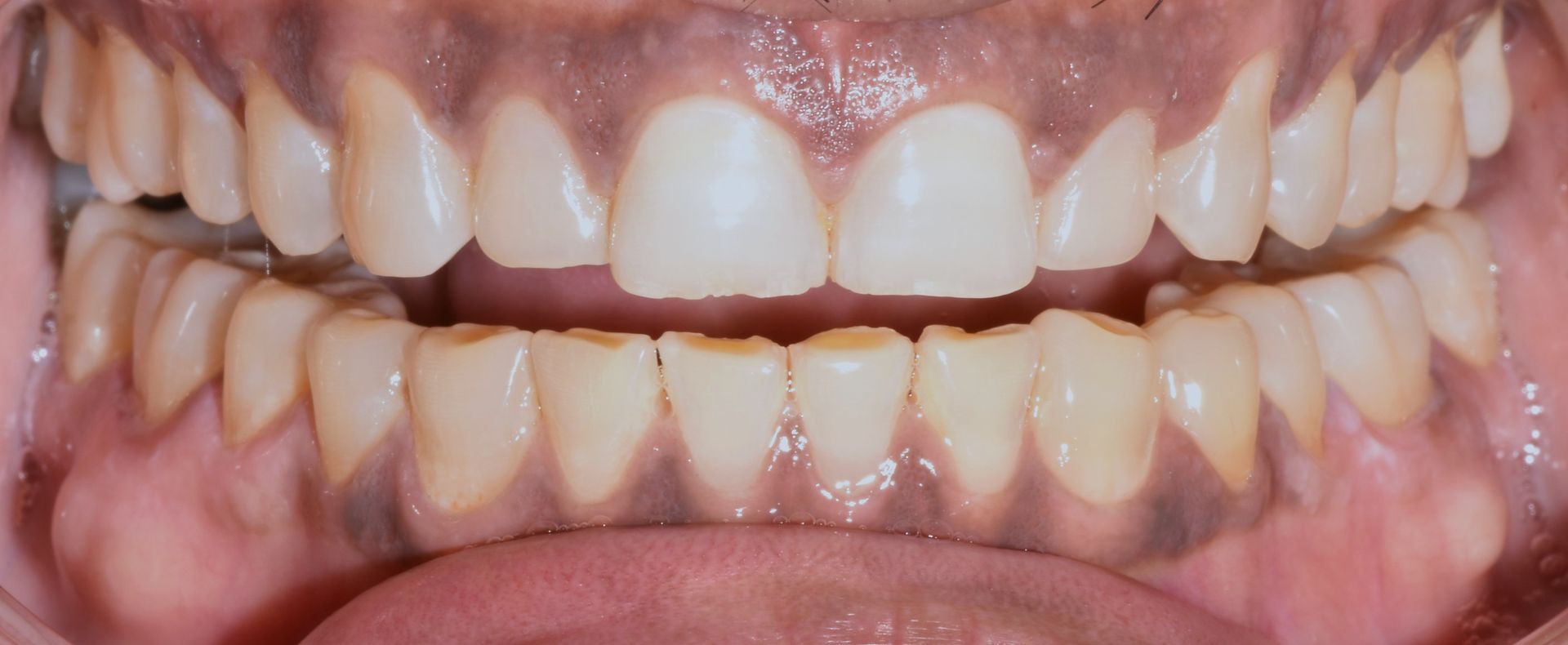 A close-up of a person's teeth and mouth