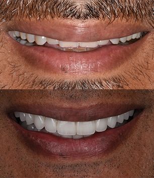 A before and after picture of a full-mouth rehabilitation case using veneers