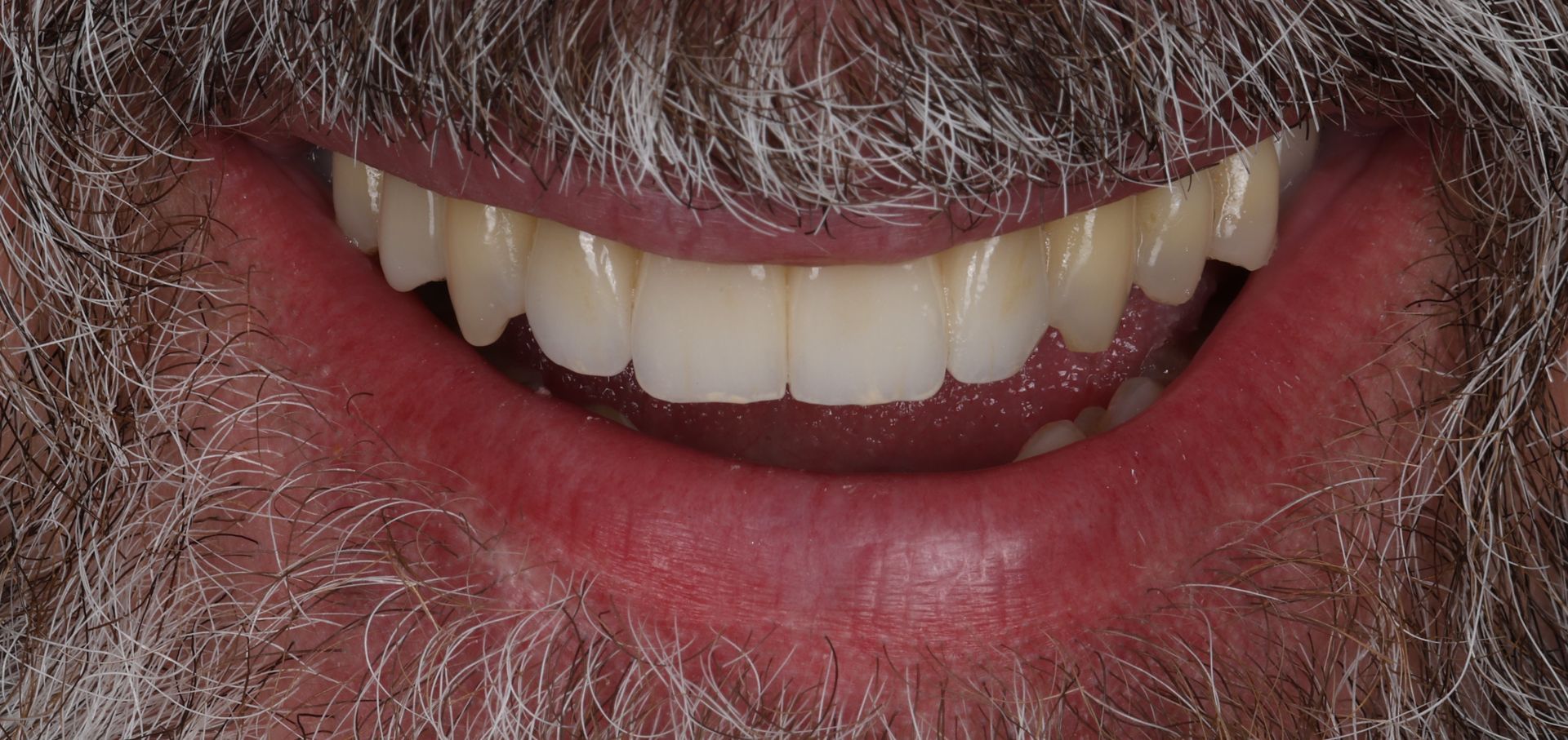 A close up of a man 's mouth with a beard and white teeth.