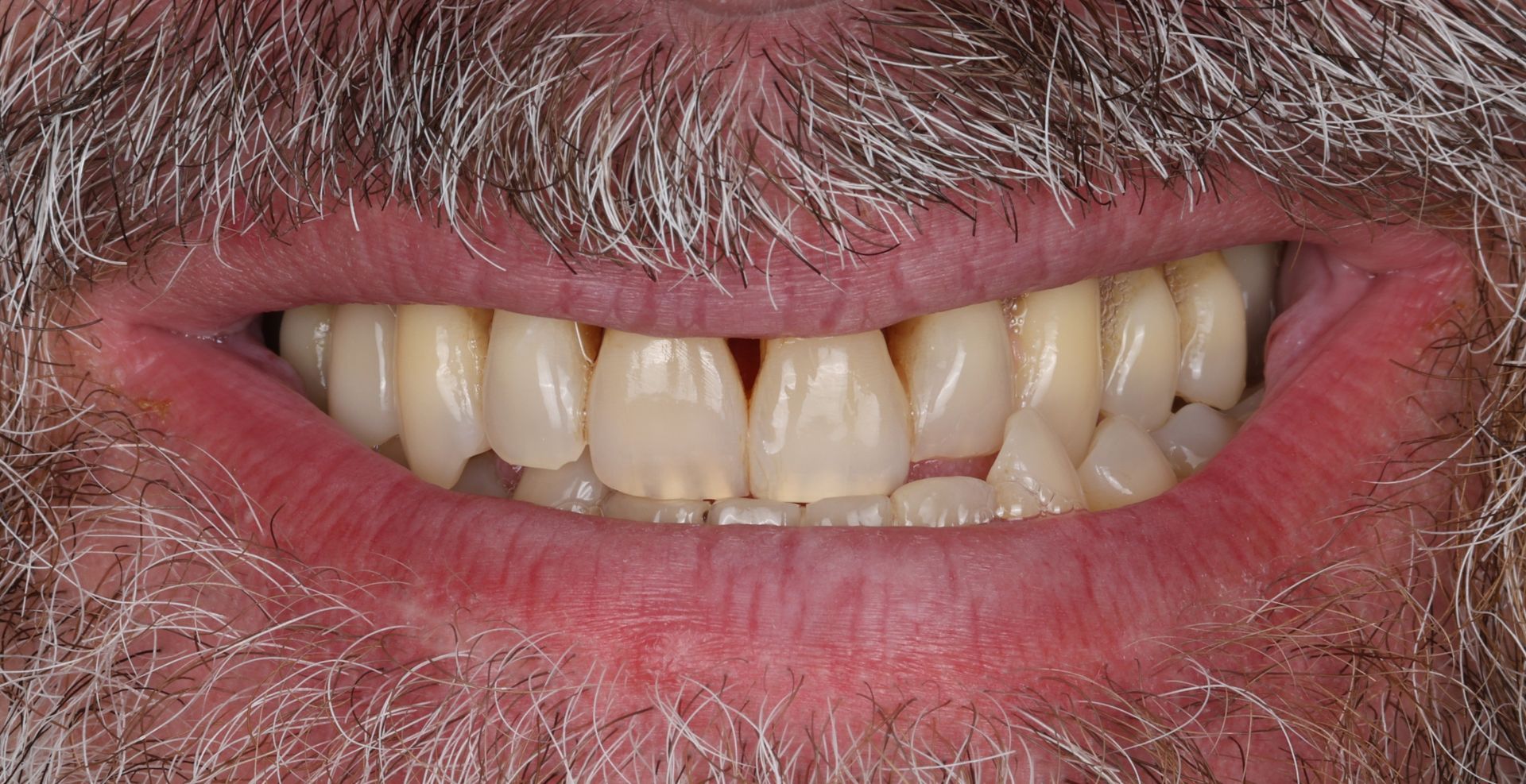 A close up of a man 's mouth with a beard and teeth.