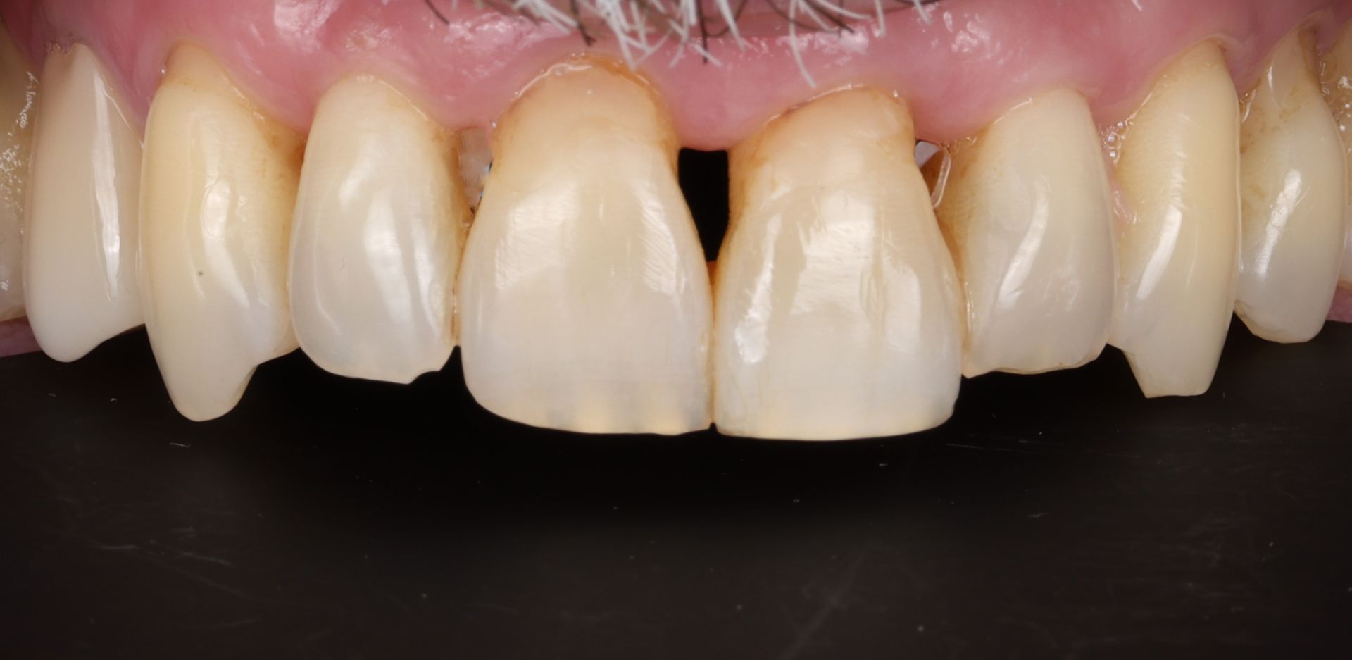 A close up of a person 's teeth with a hole in the middle.