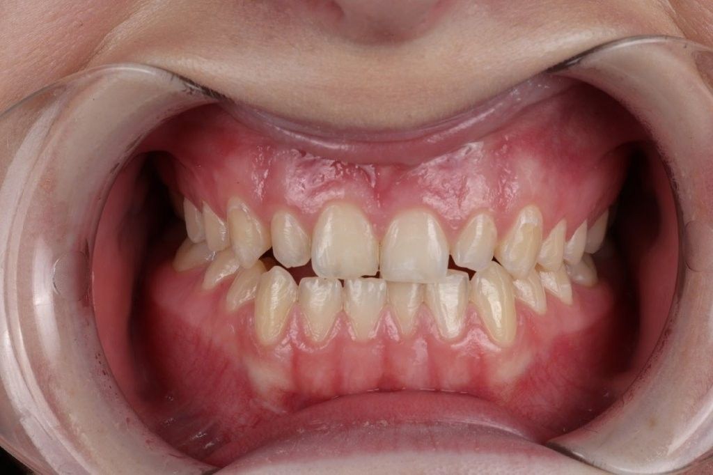 Open mouth showing crowded teeth with a clear bite misalignment