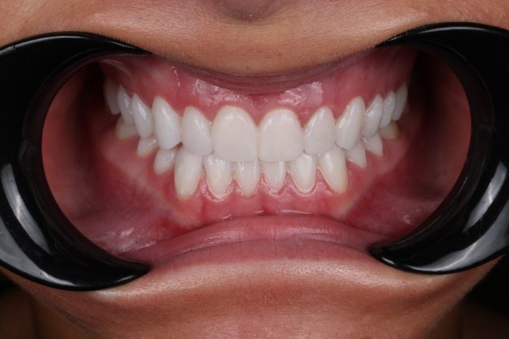 Close-up of a mouth retracted with black cheek retractors, showing teeth and gums.