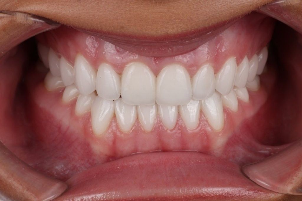 Close-up of a smiling mouth showing straight white teeth and pink gums