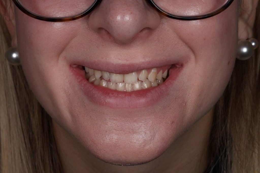 Close-up of a smiling mouth with braces and pearl earrings, wearing glasses