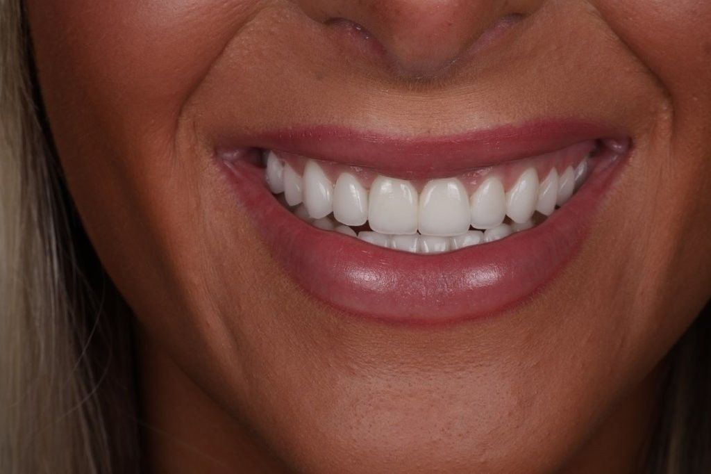 Close-up of a smiling mouth with bright white teeth and pink lips