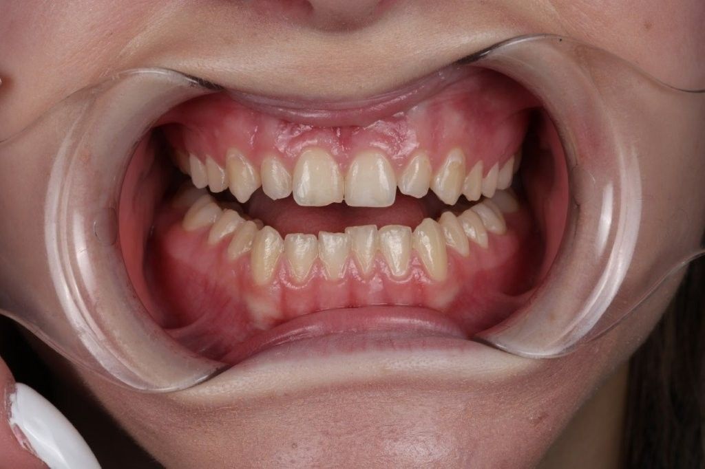 Close-up of open mouth with dental cheek retractors showing teeth and gums