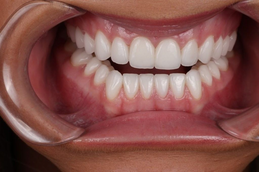 Close-up of a mouth with retractors, showing white upper and lower teeth and gums