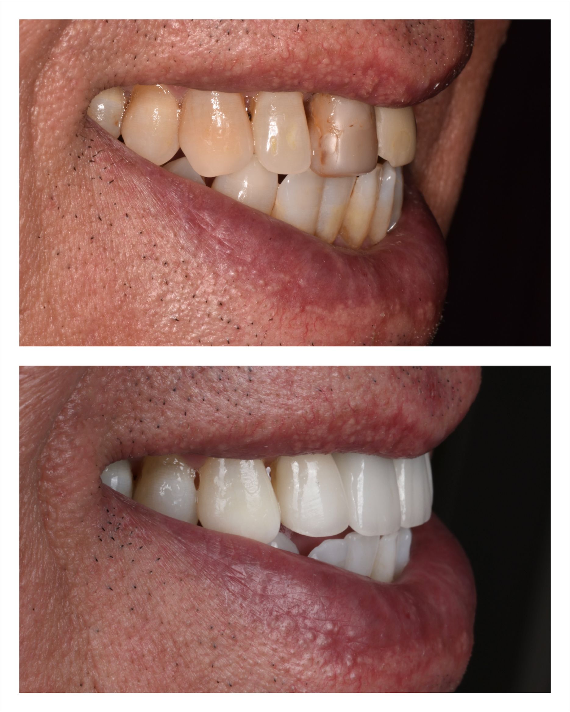 side-by-side comparison of teeth before and after cosmetic dentistry