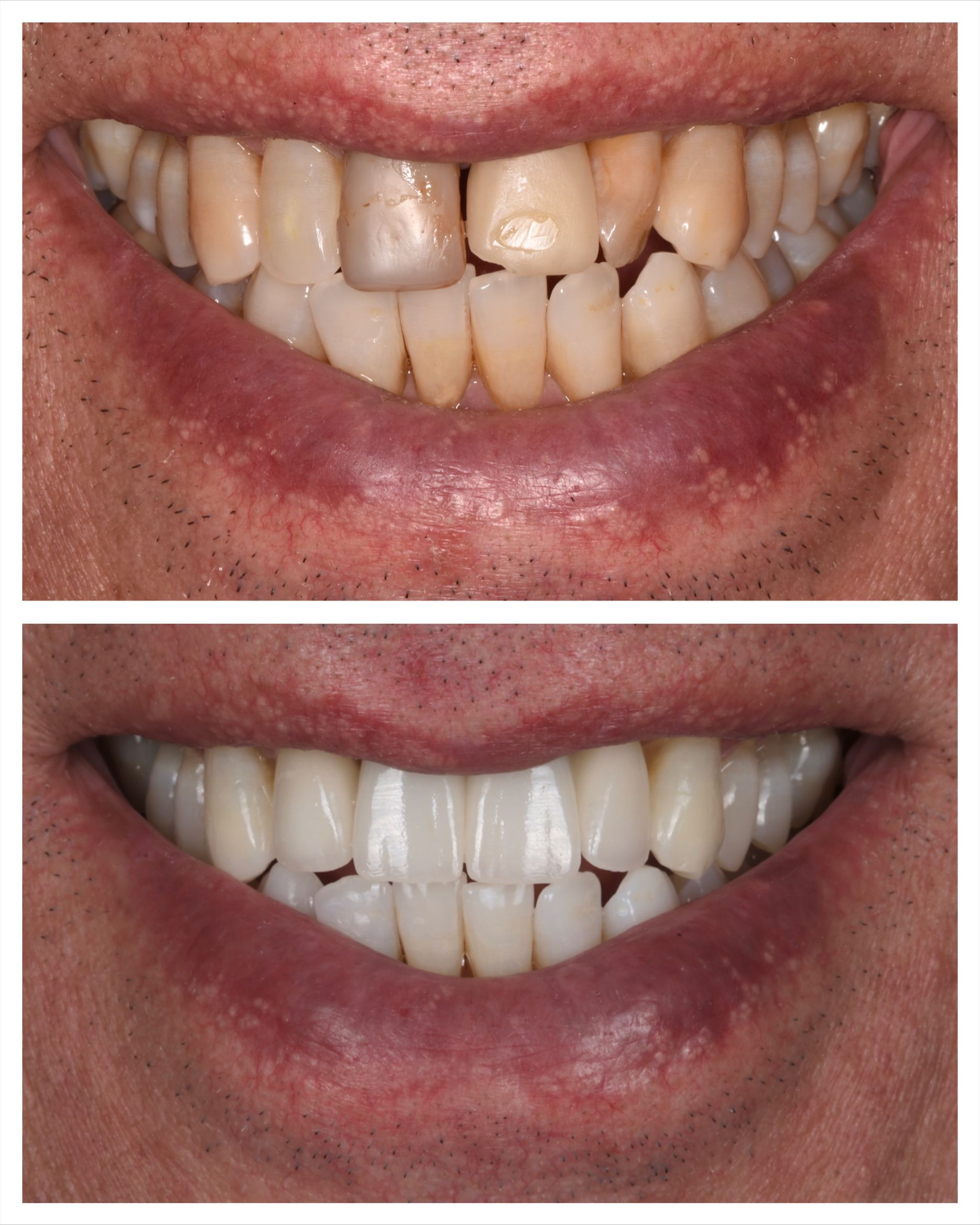 before and after photos of a smile, discolored and chipped teeth on top and bright, even, white teeth at the bottom