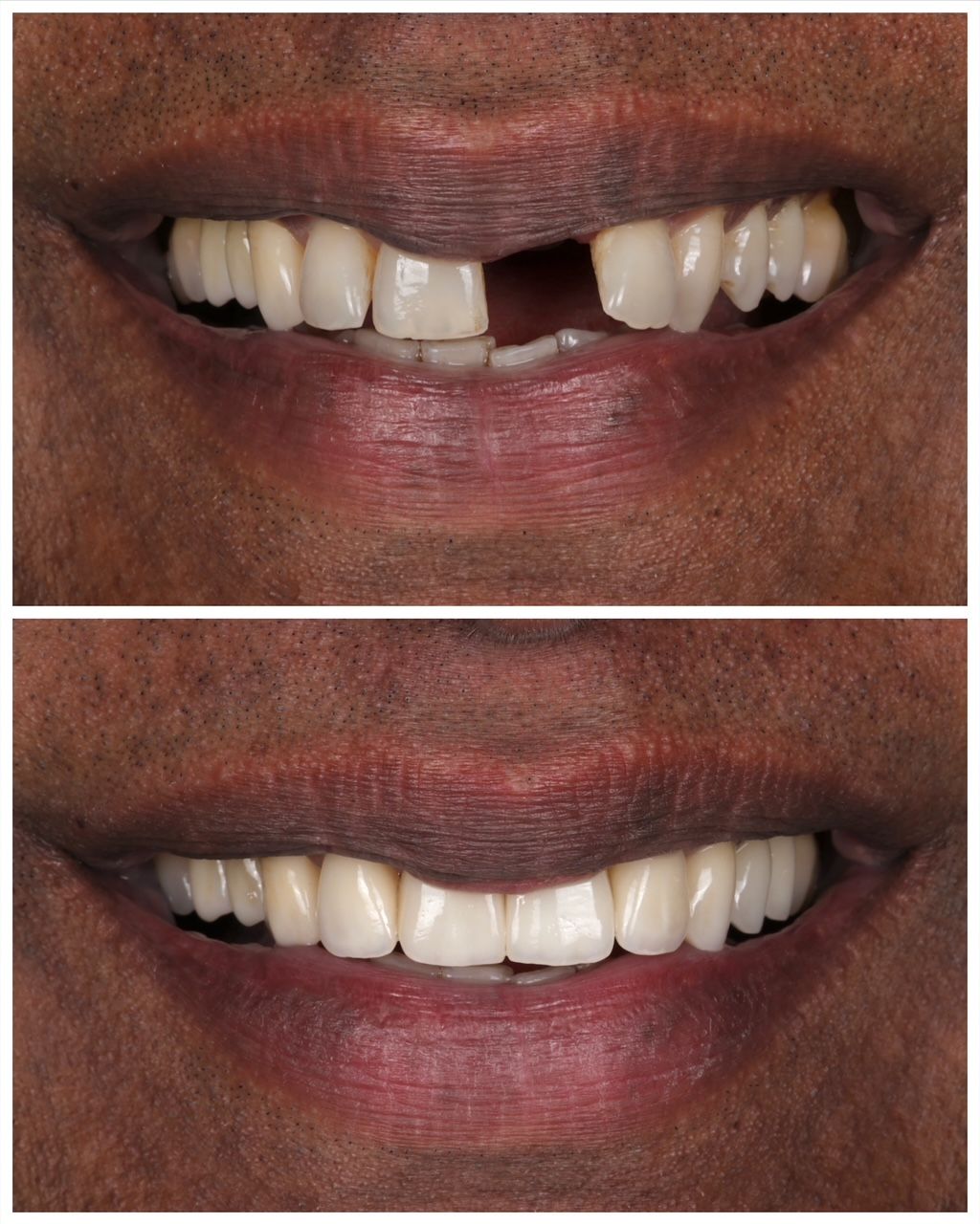 Before and after comparison of a dental procedure showing a missing upper tooth replaced with a bridge.