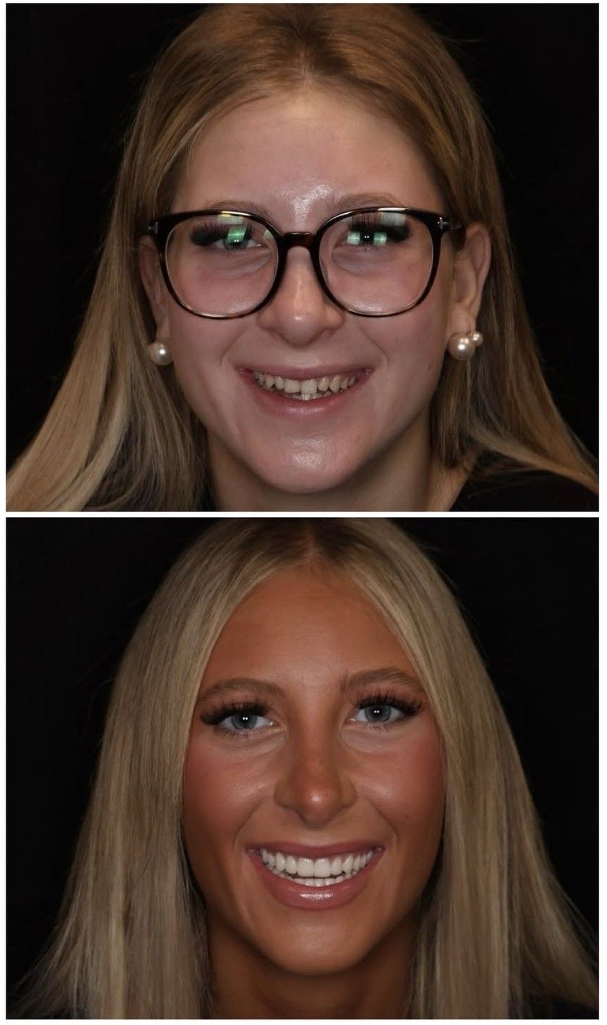 Before and after teeth images of Ella