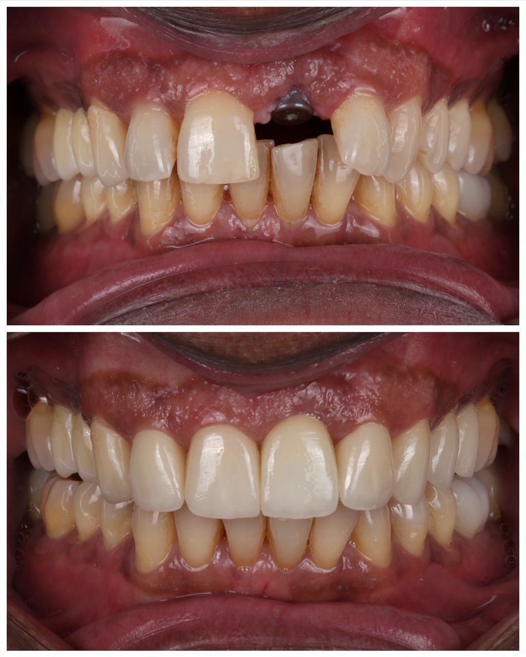 Before and after comparison of a patient’s teeth, showing a dental implant restoration replacing a missing front tooth.