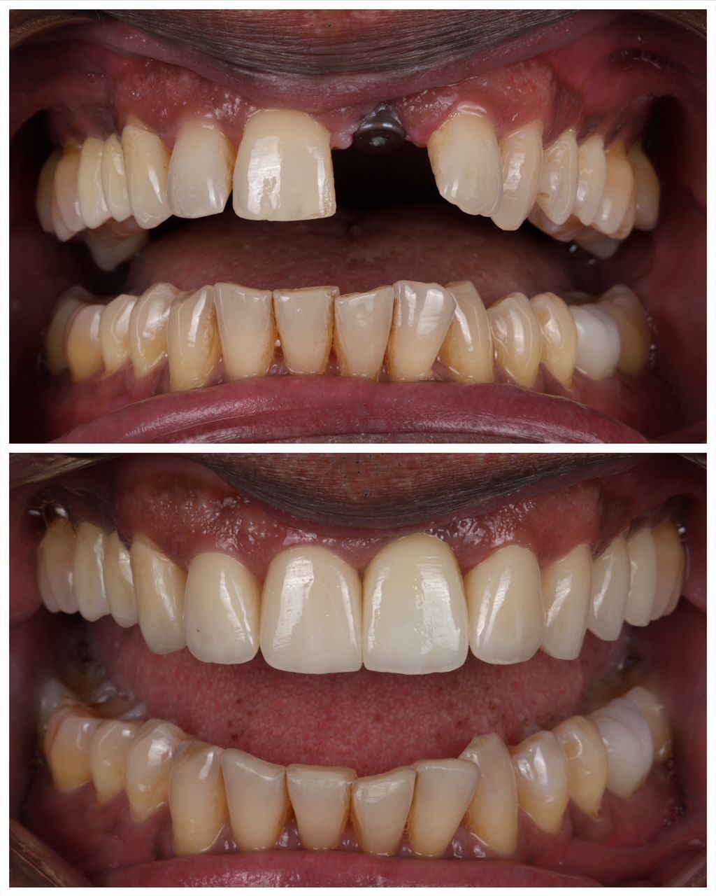 Before and after view of a dental restoration showing a replaced front tooth and improved smile.