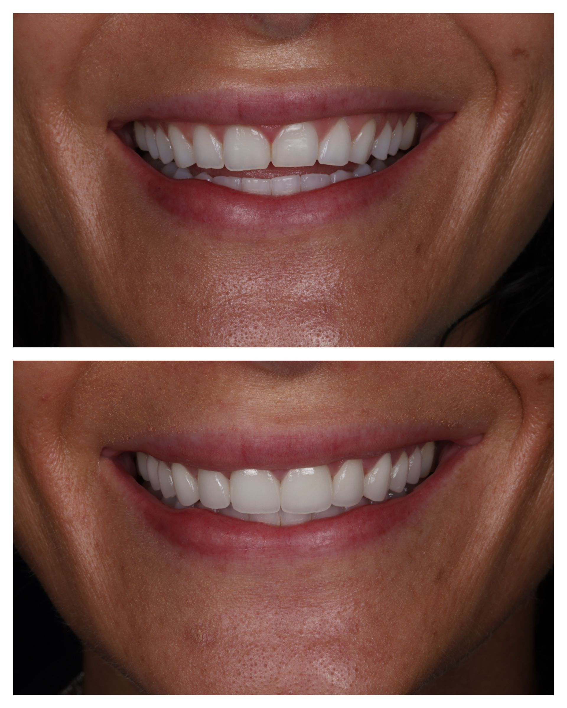 Before-and-after close-up of a smiling mouth showing teeth, with less visible gum and tooth exposure in the lower image