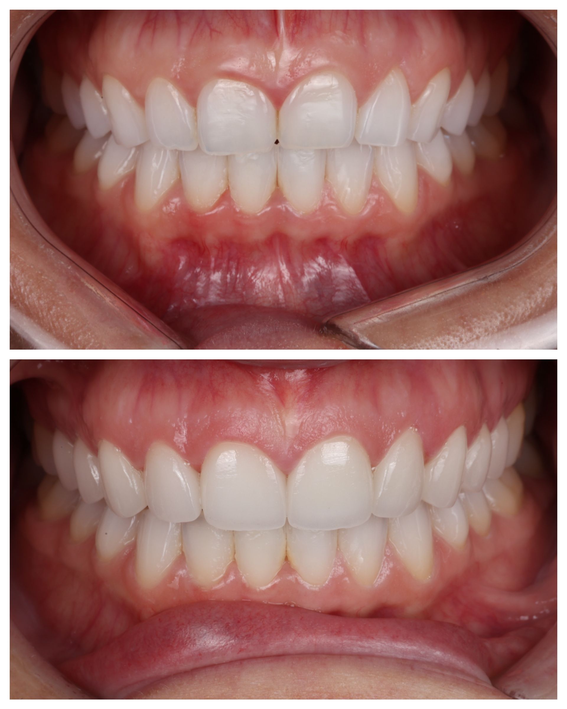 Two close-up dental photos comparing tooth alignment, with one showing a front tooth gap and the other showing closed teeth.