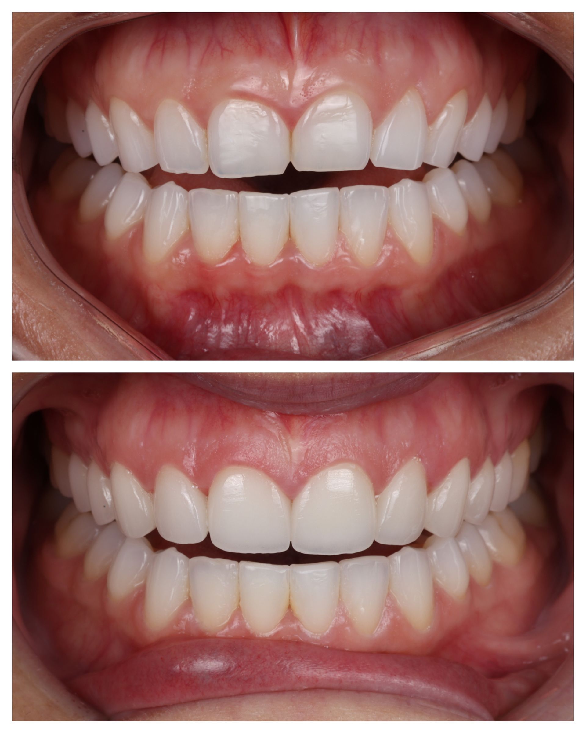 Split photo of teeth before and after whitening, showing brighter upper and lower teeth
