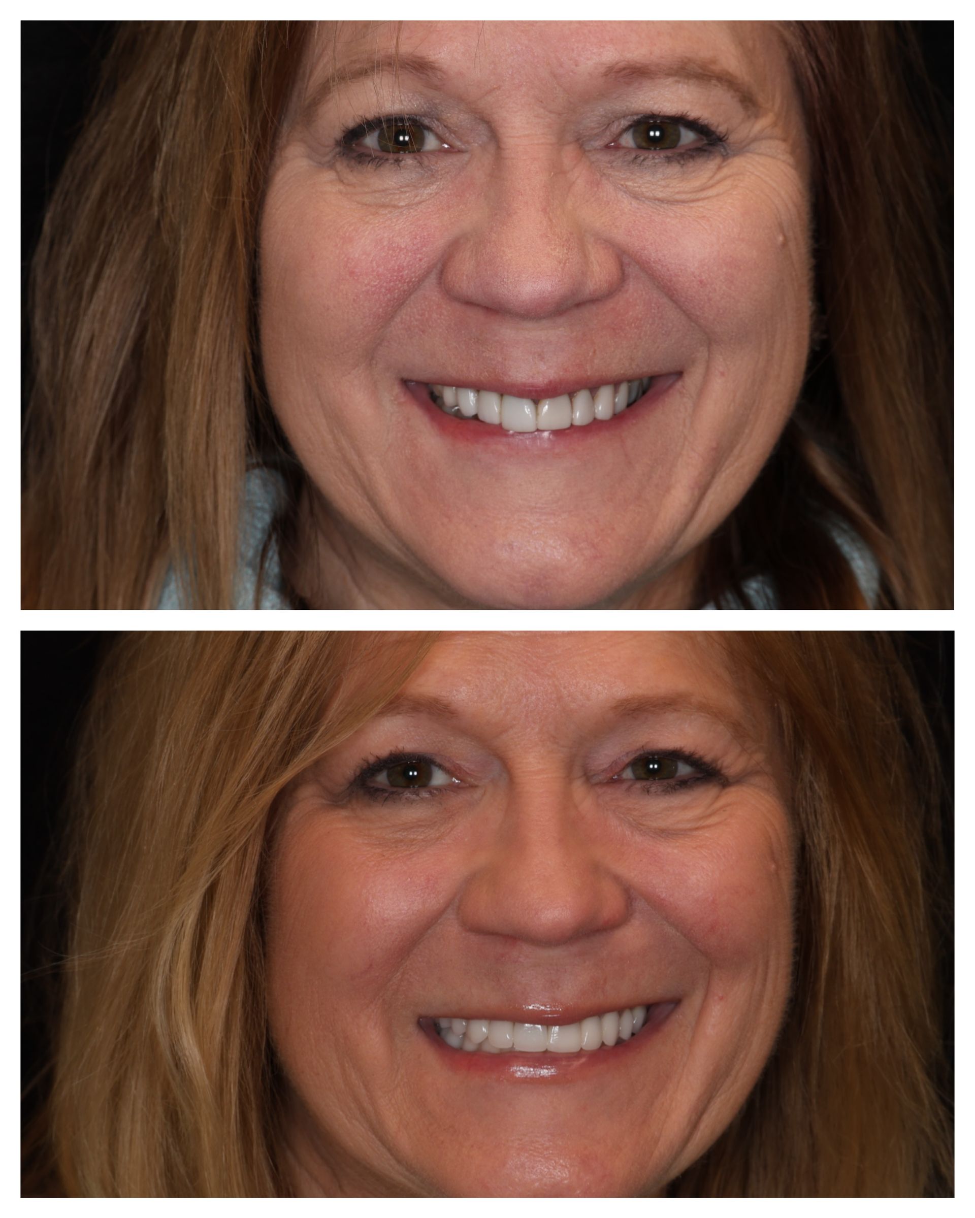 Before and after teeth images of Deb R.