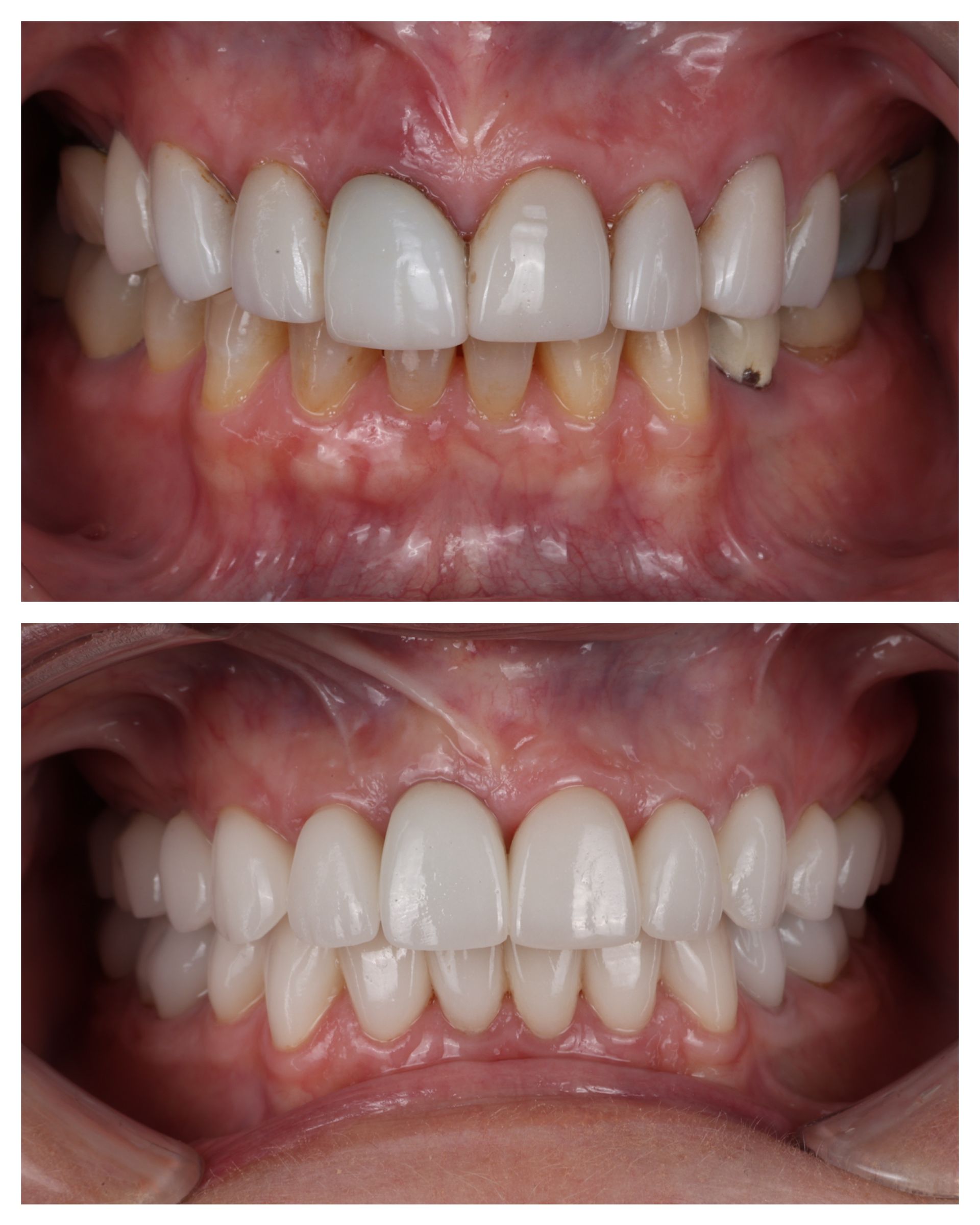 Before-and-after close-up of teeth alignment, showing crooked teeth corrected to a straight smile.