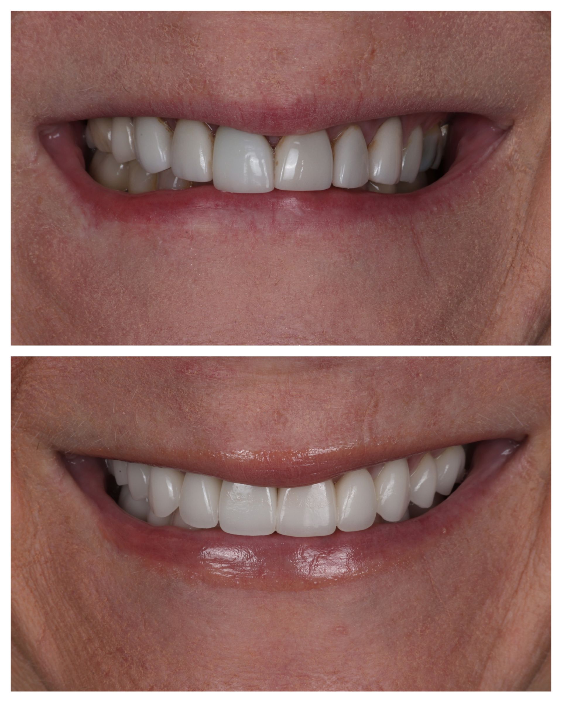 Two close-up smiles comparing front teeth before and after whitening or straightening