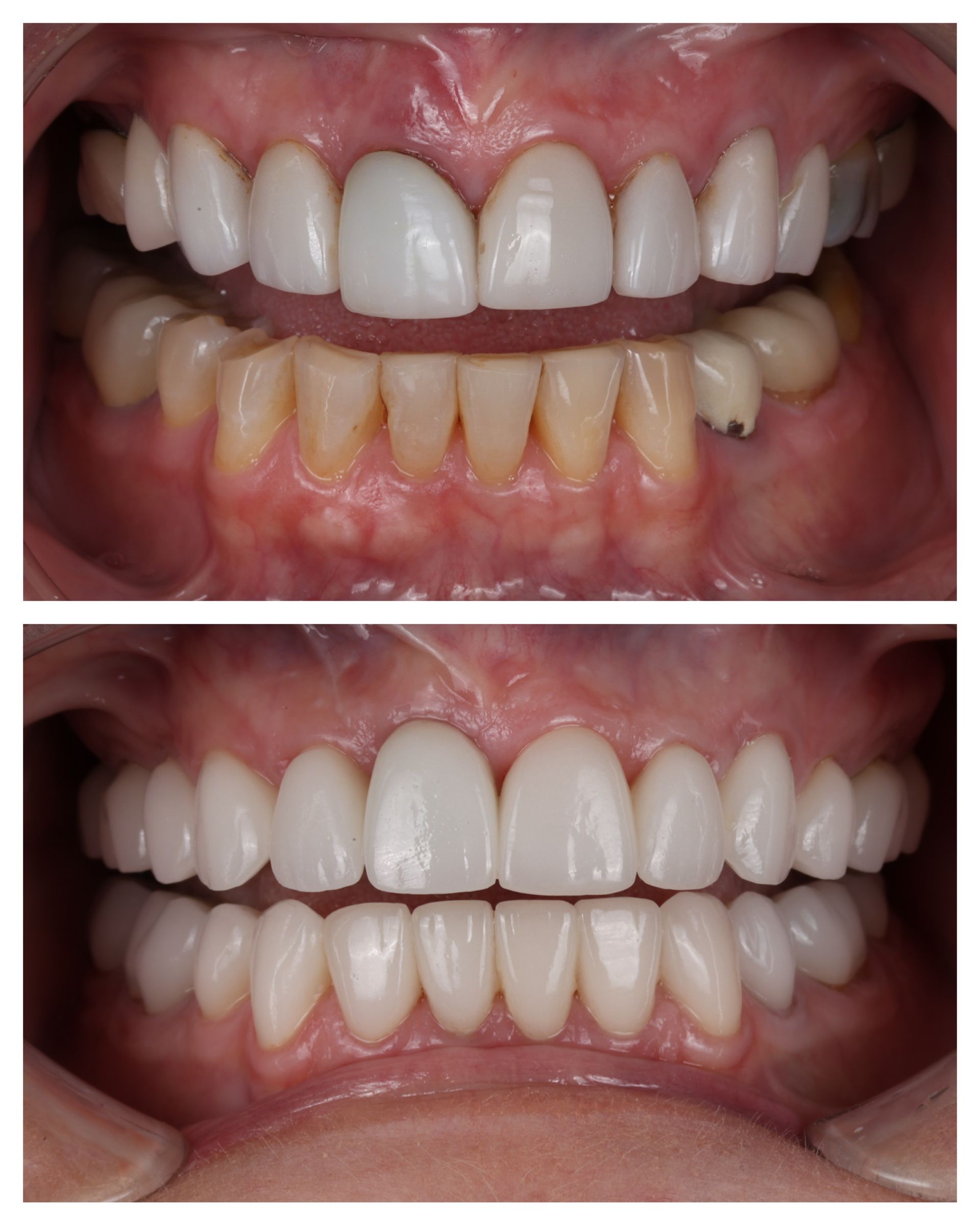 Before-and-after close-up of teeth and gums showing dental alignment improvement