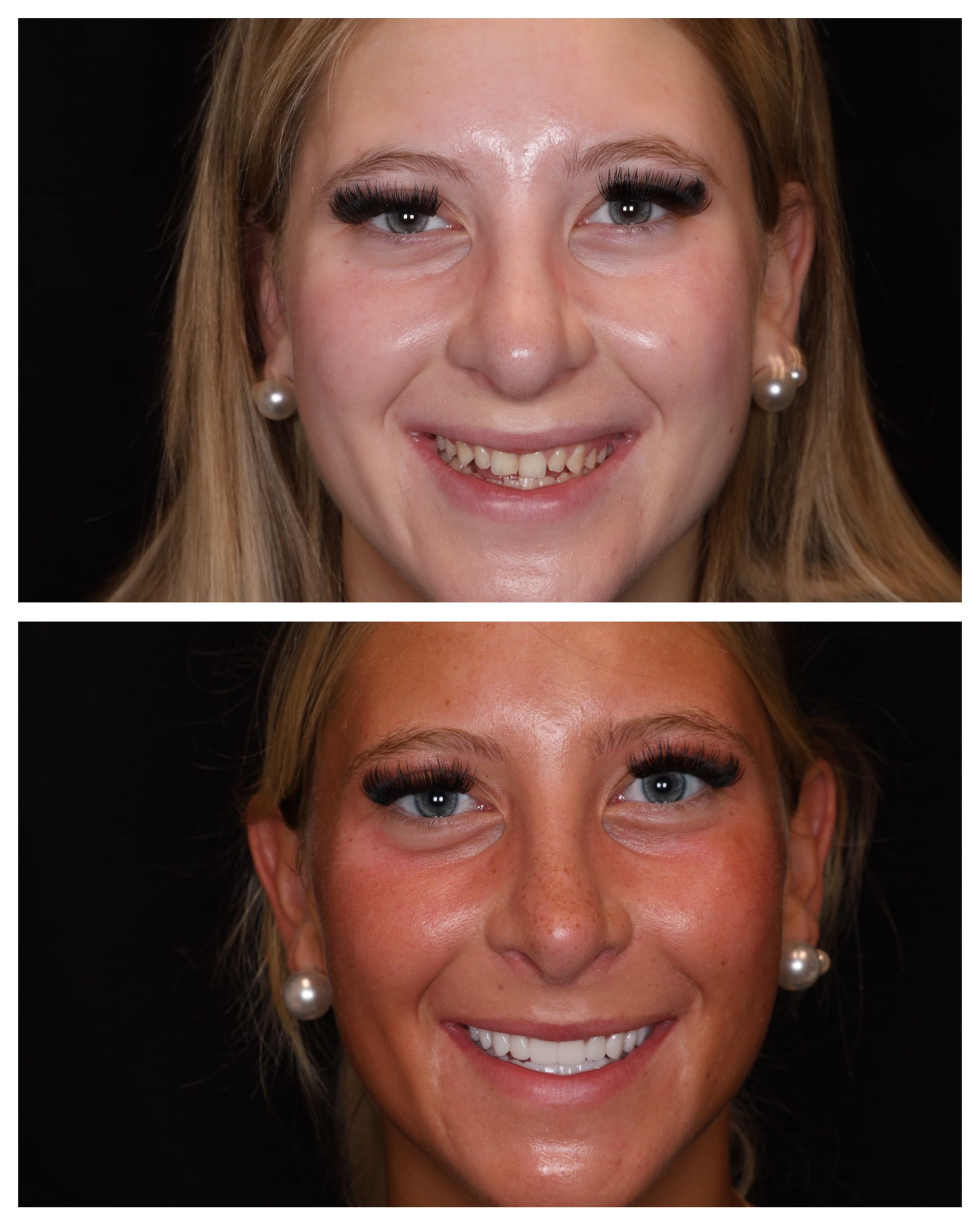 Before and after teeth images of Ella