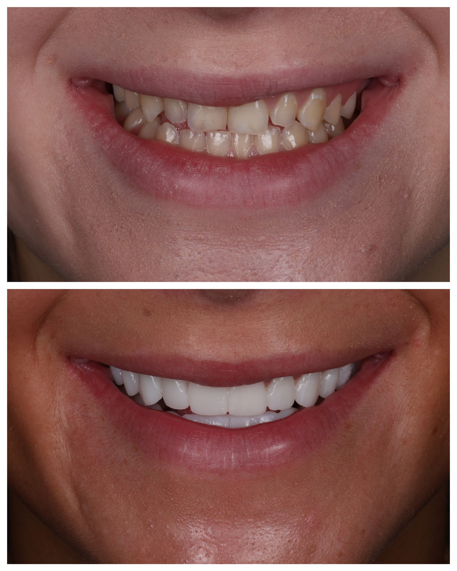 Before-and-after close-up of a smiling mouth with discolored teeth changed to bright white teeth.