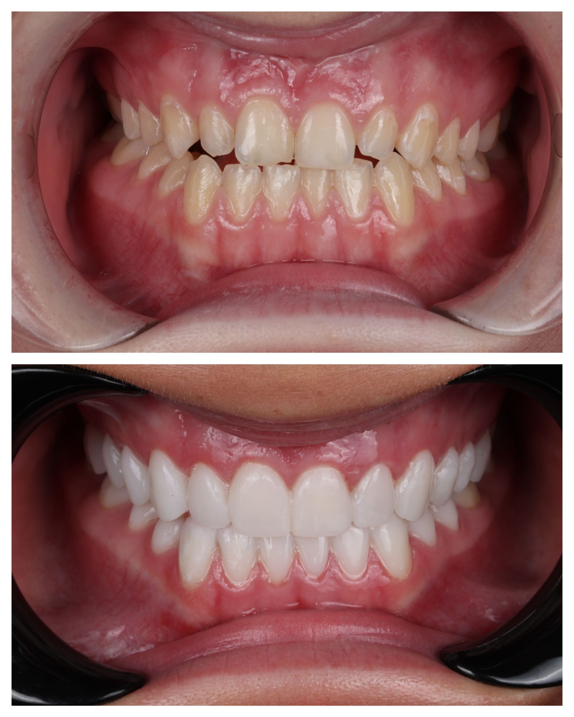 Two close-up mouth photos showing teeth before and after whitening treatment.