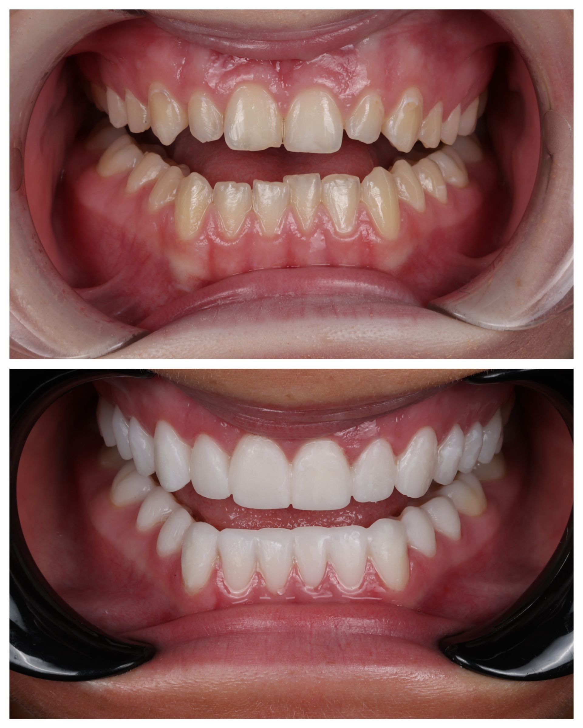 Before-and-after close-up of teeth whitening: yellowish teeth above, bright white teeth below.