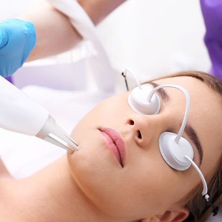 A woman is getting a laser treatment on her face.