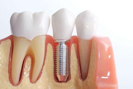 A model of a tooth with a dental implant in it.