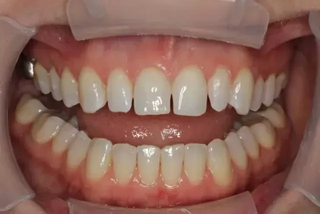 A close up of a person 's teeth with braces on them.