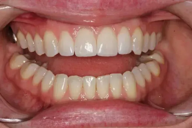 A close up of a person 's mouth with white teeth.