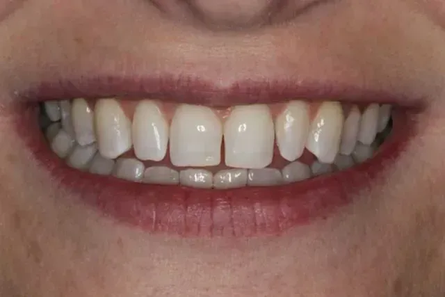 A close up of a woman 's smile with white teeth and red lips.