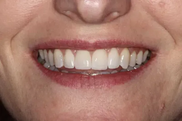 A close up of a woman 's smile with white teeth and red lips.