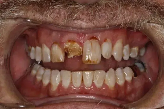 A close up of a man 's mouth with missing teeth.