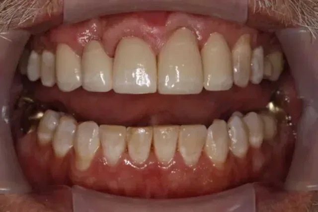 A close up of a man 's teeth with dental braces.