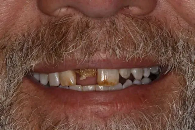A man with a beard and missing teeth is smiling.
