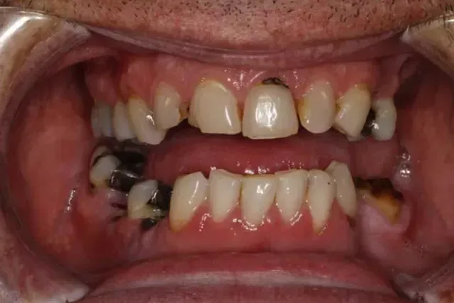 A close up of a man 's mouth with a lot of teeth missing.