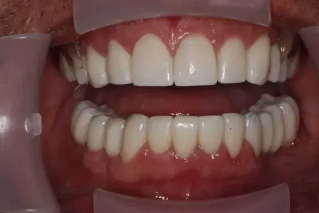 A close up of a person 's teeth with braces.