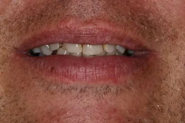 A close up of a man 's mouth with missing teeth.