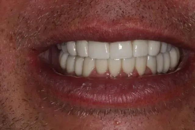 A close up of a man 's mouth with white teeth.