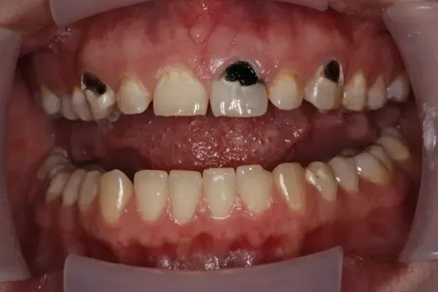 A close up of a person 's teeth with holes in them.