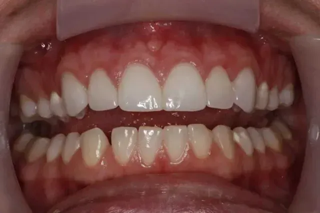 A close up of a person 's teeth with white teeth.