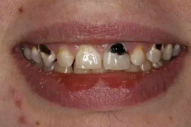 A close up of a person 's teeth with a lot of black spots on them.