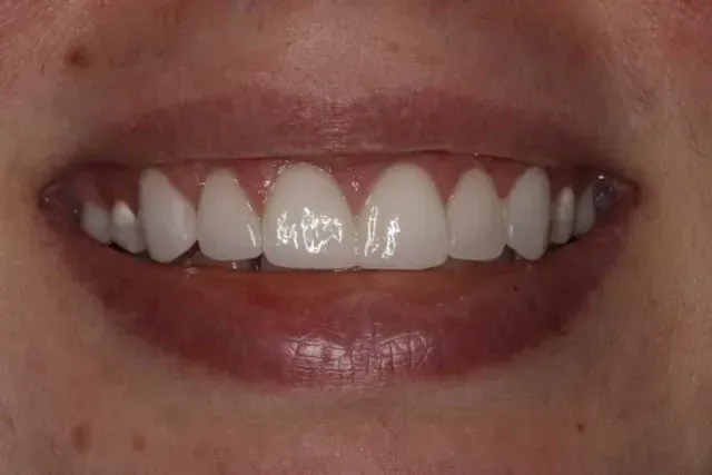 A close up of a woman 's smile with white teeth.