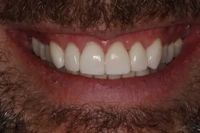 A close up of a man 's smile with white teeth and a beard.