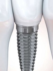 A close up of a dental implant between two teeth.