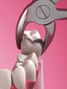 A pair of dental pliers is being used to remove a tooth.